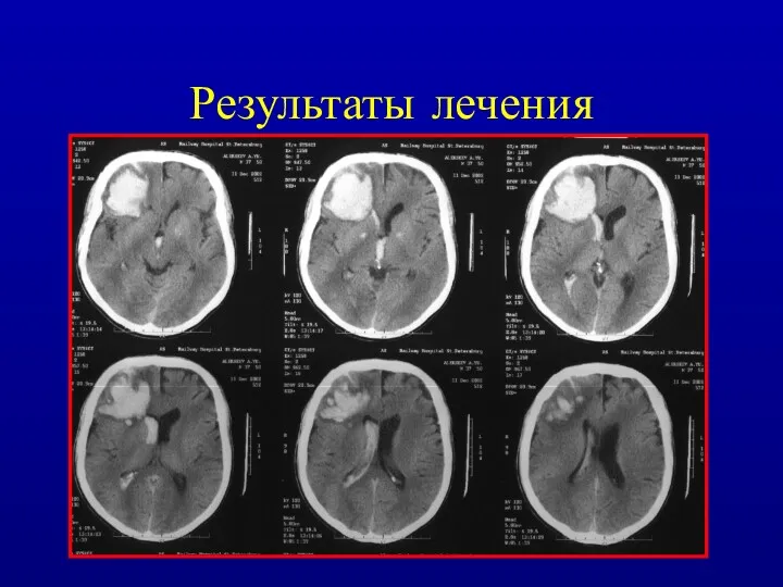 Результаты лечения