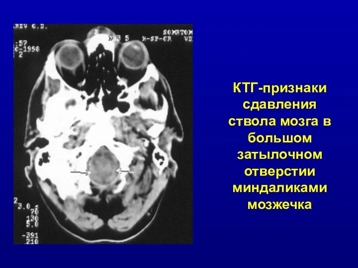 КТГ-признаки сдавления ствола мозга в большом затылочном отверстии миндаликами мозжечка
