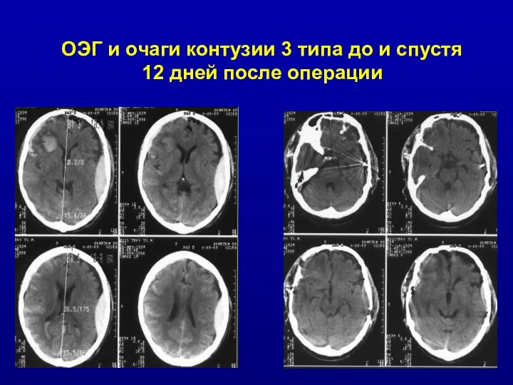 ОЭГ и очаги контузии 3 типа до и спустя 12 дней после операции