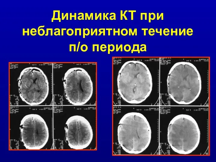 Динамика КТ при неблагоприятном течение п/о периода