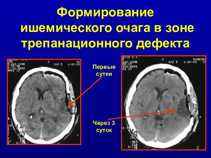 Формирование ишемического очага в зоне трепанационного дефекта Первые сутки Через 3 суток