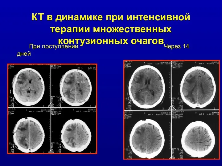 КТ в динамике при интенсивной терапии множественных контузионных очагов При поступлении Через 14 дней