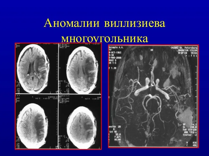 Аномалии виллизиева многоугольника