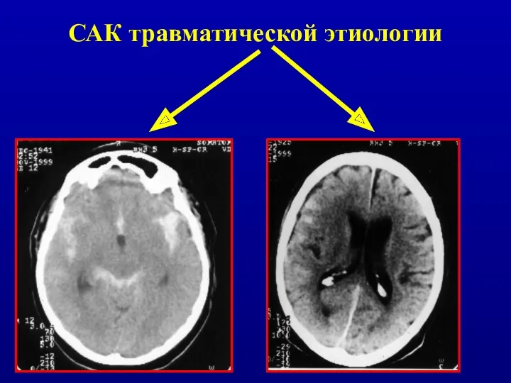 САК травматической этиологии