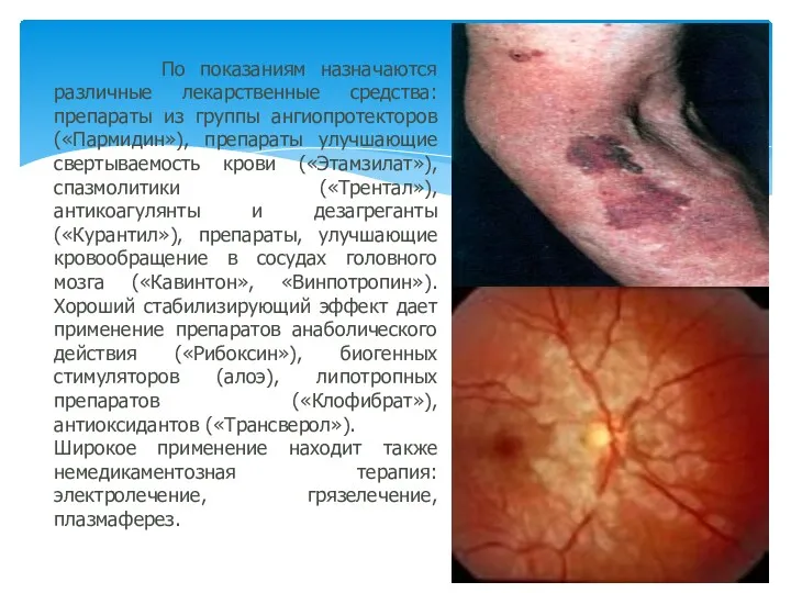 По показаниям назначаются различные лекарственные средства: препараты из группы ангиопротекторов