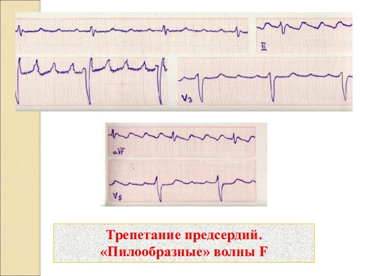Трепетание предсердий. «Пилообразные» волны F