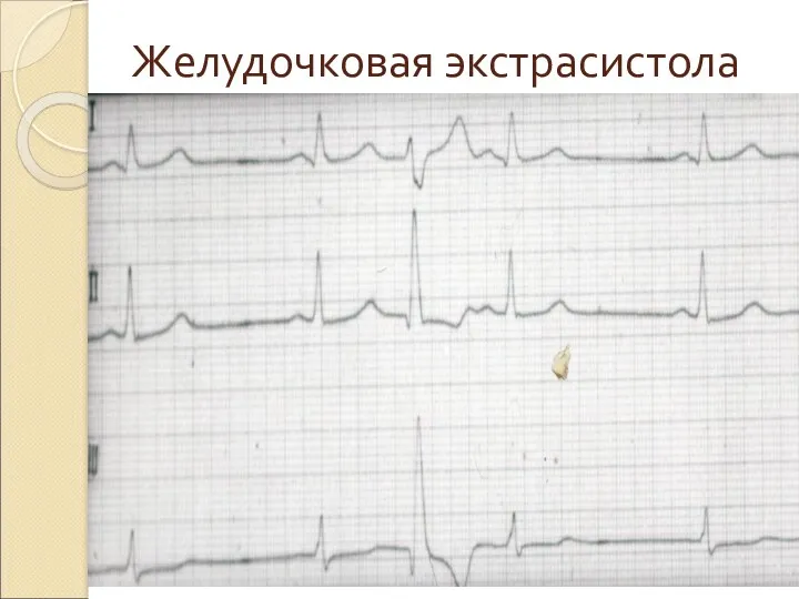 Желудочковая экстрасистола