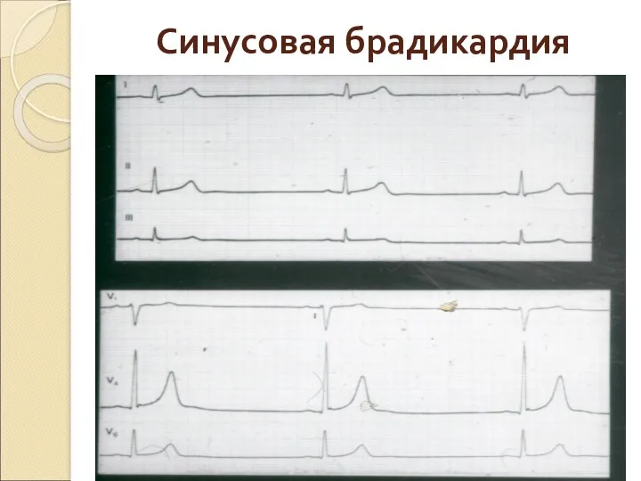 Синусовая брадикардия