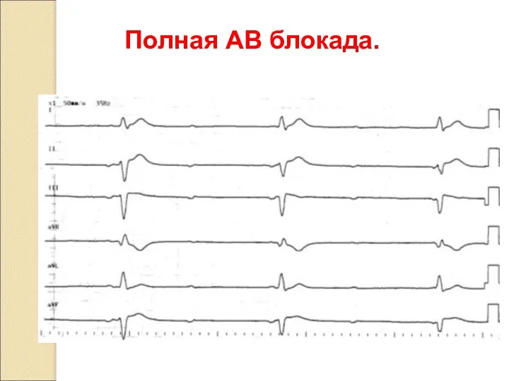 Полная АВ блокада.