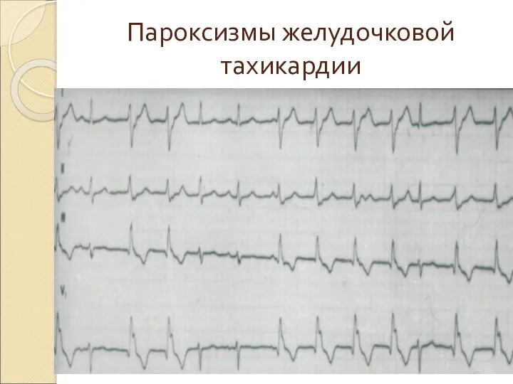 Пароксизмы желудочковой тахикардии