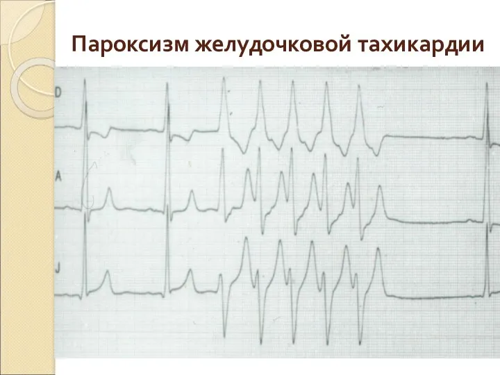 Пароксизм желудочковой тахикардии