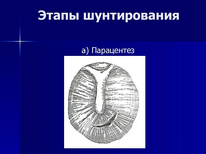 Этапы шунтирования а) Парацентез