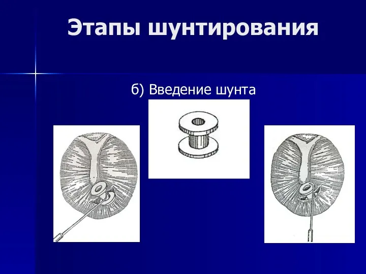 Этапы шунтирования б) Введение шунта