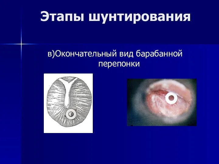 Этапы шунтирования в)Окончательный вид барабанной перепонки