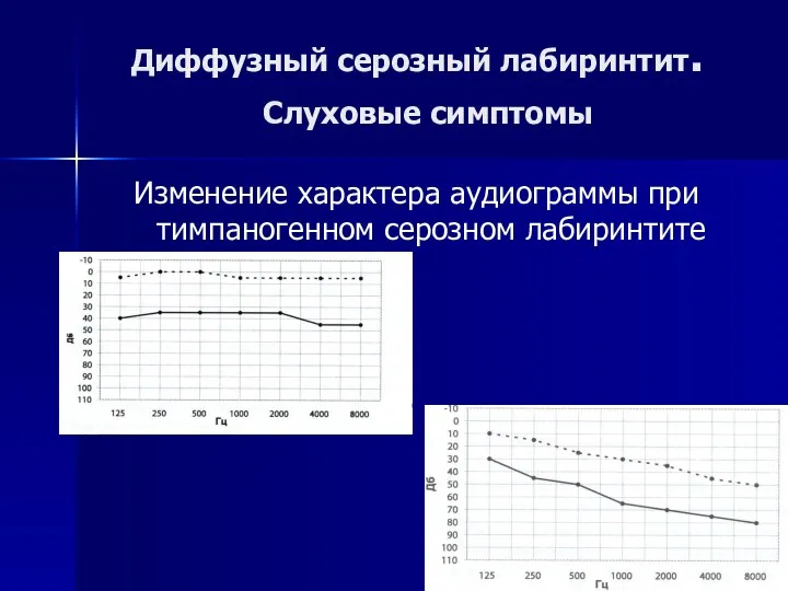 Диффузный серозный лабиринтит. Слуховые симптомы Изменение характера аудиограммы при тимпаногенном серозном лабиринтите