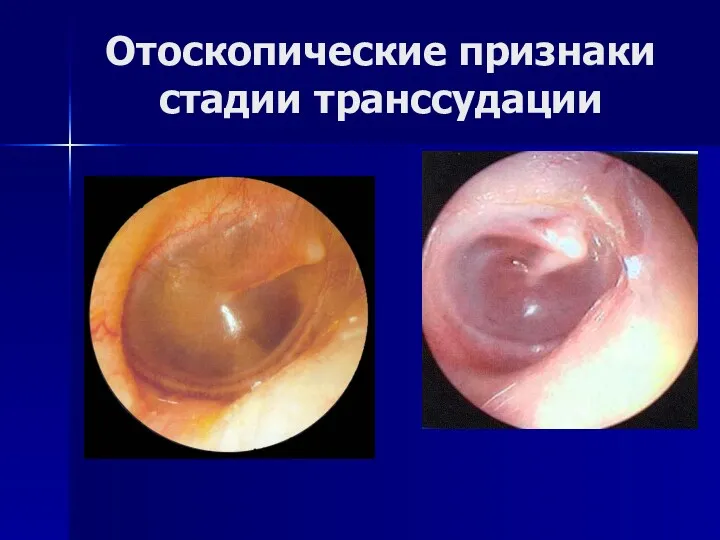 Отоскопические признаки стадии транссудации