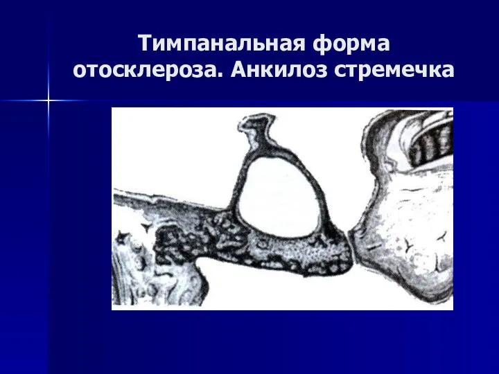 Тимпанальная форма отосклероза. Анкилоз стремечка