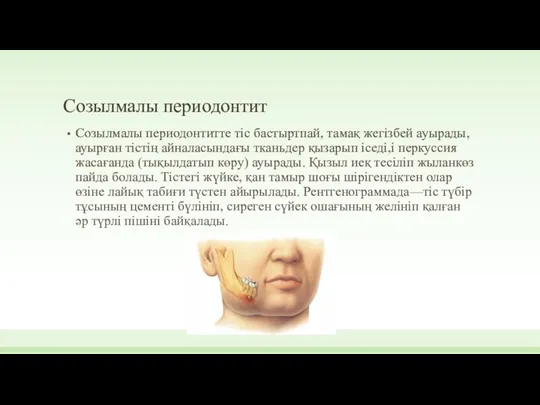 Созылмалы периодонтит Созылмалы периодонтитте тіс бастыртпай, тамақ жегізбей ауырады, ауырған