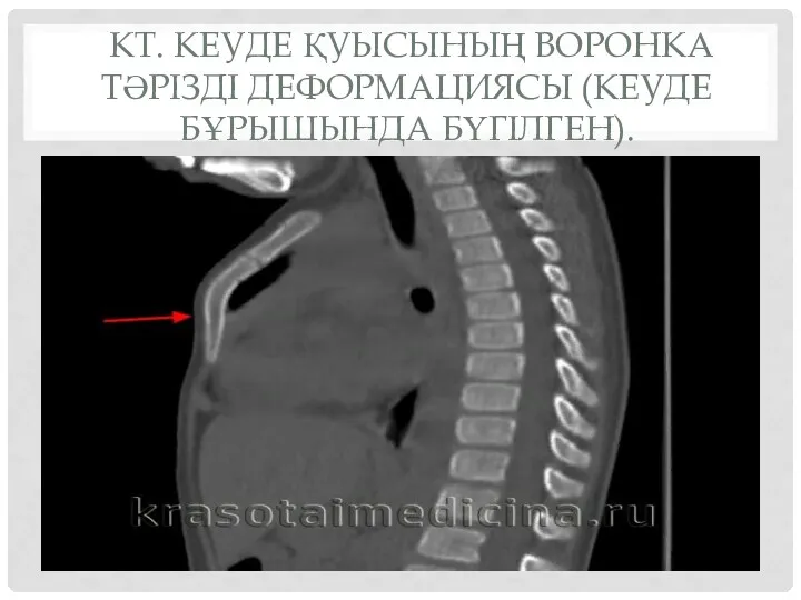 КТ. КЕУДЕ ҚУЫСЫНЫҢ ВОРОНКА ТӘРІЗДІ ДЕФОРМАЦИЯСЫ (КЕУДЕ БҰРЫШЫНДА БҮГІЛГЕН).