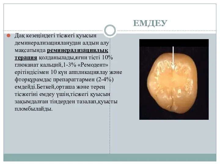 ЕМДЕУ Дақ кезеңіндегі тісжегі қуысын деминерализацияланудан алдын алу мақсатында реминерализациялық