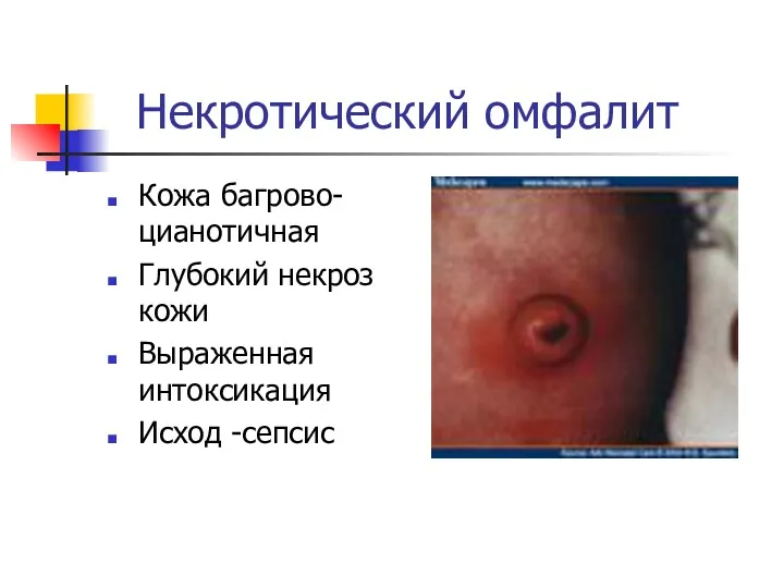 Некротический омфалит Кожа багрово-цианотичная Глубокий некроз кожи Выраженная интоксикация Исход -сепсис