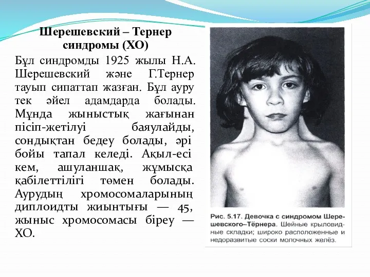 Шерешевский – Тернер синдромы (ХО) Бұл синдромды 1925 жылы Н.А.Шерешевский