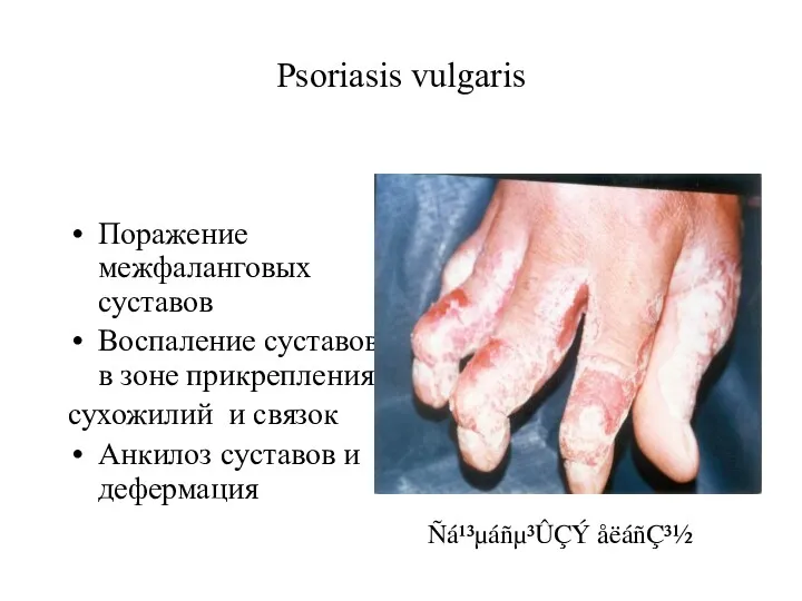 Psoriasis vulgaris Поражение межфаланговых суставов Воспаление суставов в зоне прикрепления сухожилий и связок
