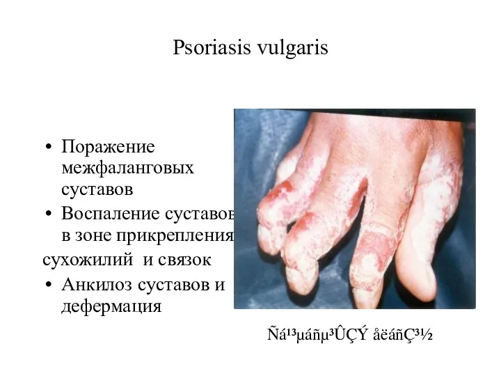 Psoriasis vulgaris Поражение межфаланговых суставов Воспаление суставов в зоне прикрепления