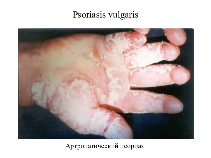 Psoriasis vulgaris Артропатический псориаз