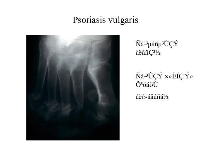 Psoriasis vulgaris Ñá¹³µáñµ³ÛÇÝ åëáñÇ³½ Ñá¹³ÛÇÝ ×»ËÏÇ Ý»Õ³óáõÙ áëï»áåáñá½