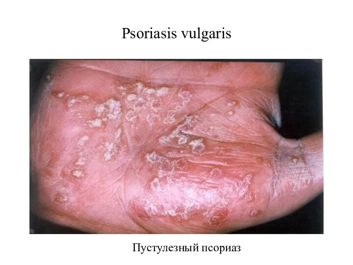 Psoriasis vulgaris Пустулезный псориаз
