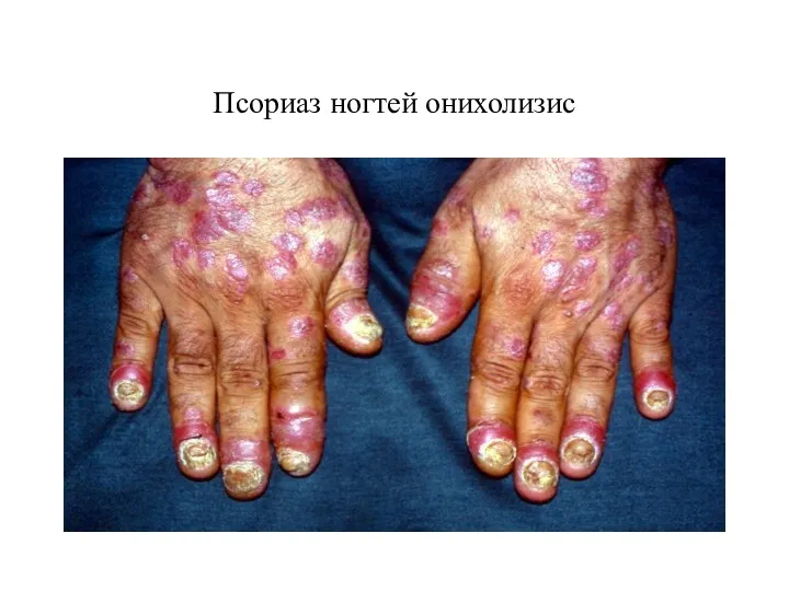 Псориаз ногтей онихолизис