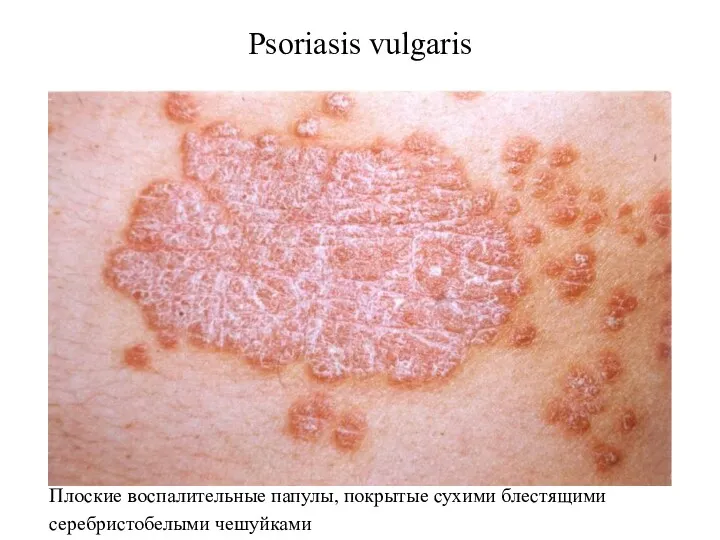 Psoriasis vulgaris Плоские воспалительные папулы, покрытые сухими блестящими серебристобелыми чешуйками