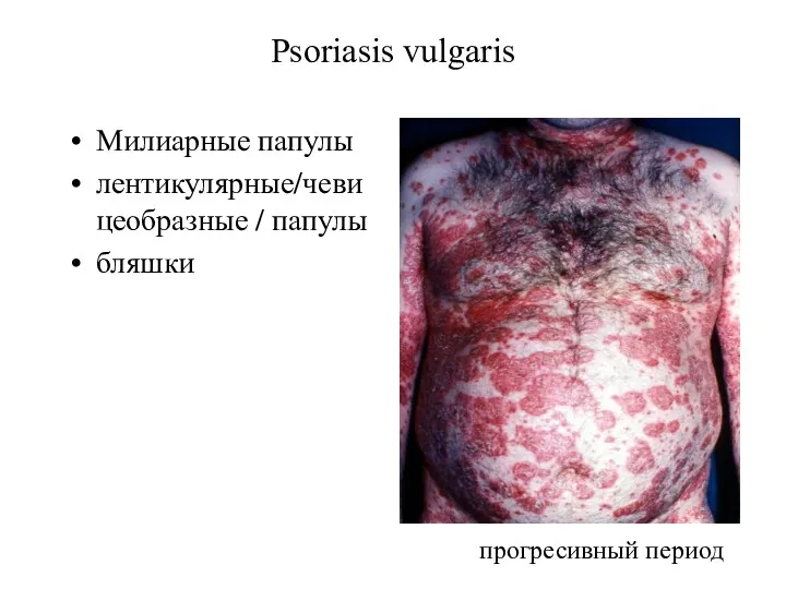 Psoriasis vulgaris Милиарные папулы лентикулярные/чевицеобразные / папулы бляшки прогресивный период
