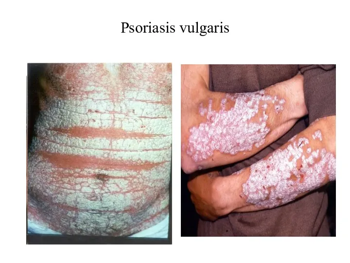 Psoriasis vulgaris ëï³óÇáÝ³ñ ßñç³Ý