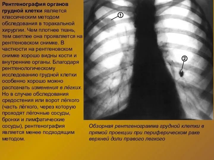 Рентгенография органов грудной клетки является классическим методом обследования в торакальной