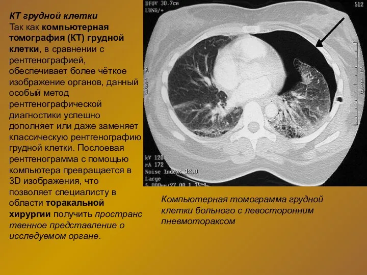 КТ грудной клетки Так как компьютерная томография (КТ) грудной клетки,