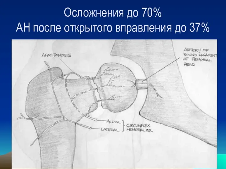 Осложнения до 70% АН после открытого вправления до 37%