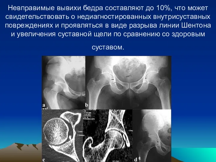 Невправимые вывихи бедра составляют до 10%, что может свидетельствовать о