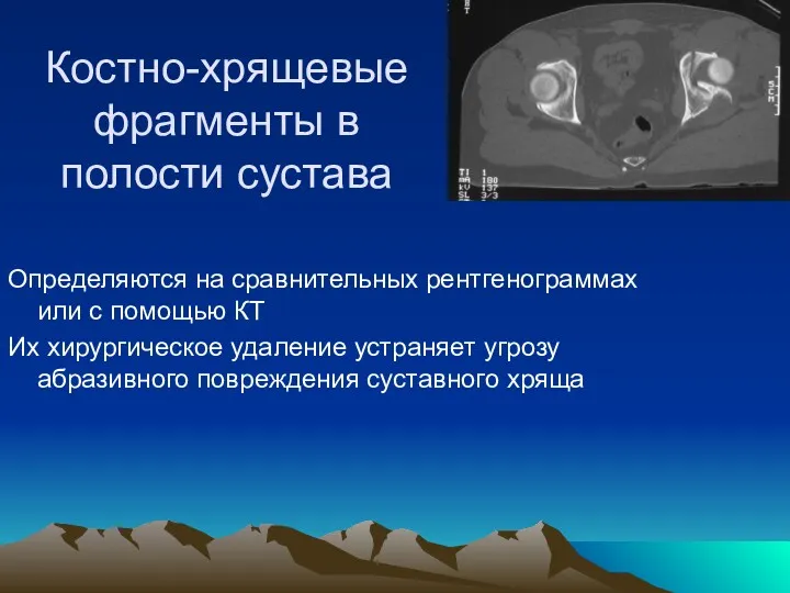 Костно-хрящевые фрагменты в полости сустава Определяются на сравнительных рентгенограммах или