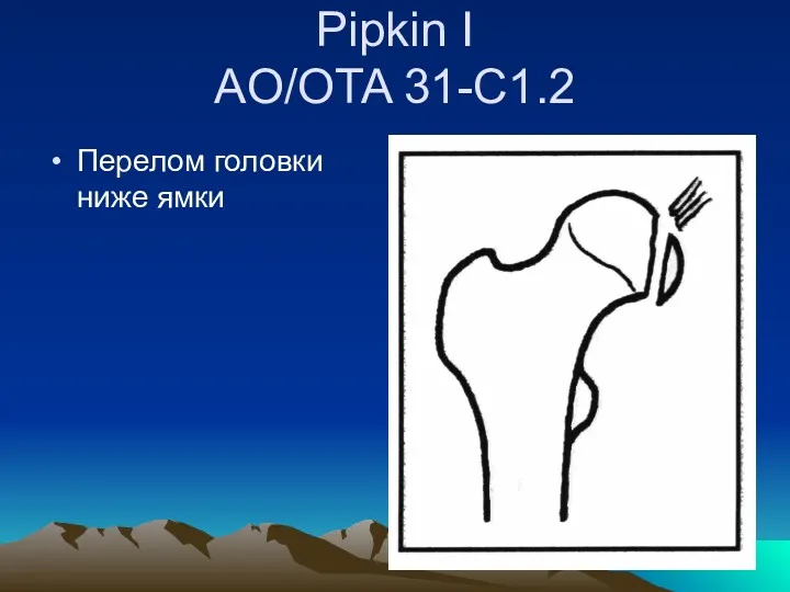 Pipkin I AO/OTA 31-C1.2 Перелом головки ниже ямки