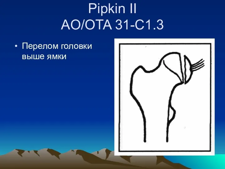 Pipkin II AO/OTA 31-C1.3 Перелом головки выше ямки