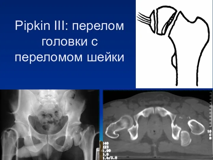 Pipkin III: перелом головки с переломом шейки .