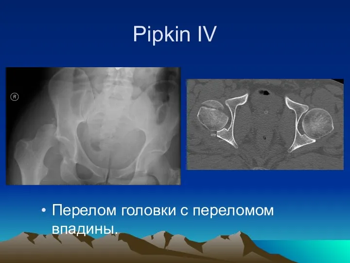 Pipkin IV Перелом головки с переломом впадины.