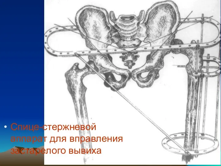 Спице-стержневой аппарат для вправления застарелого вывиха