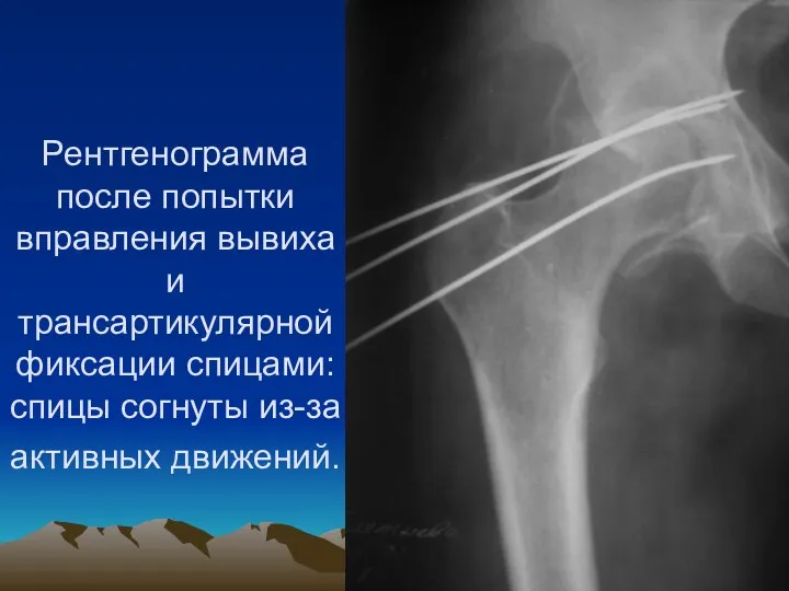Рентгенограмма после попытки вправления вывиха и трансартикулярной фиксации спицами: спицы согнуты из-за активных движений.