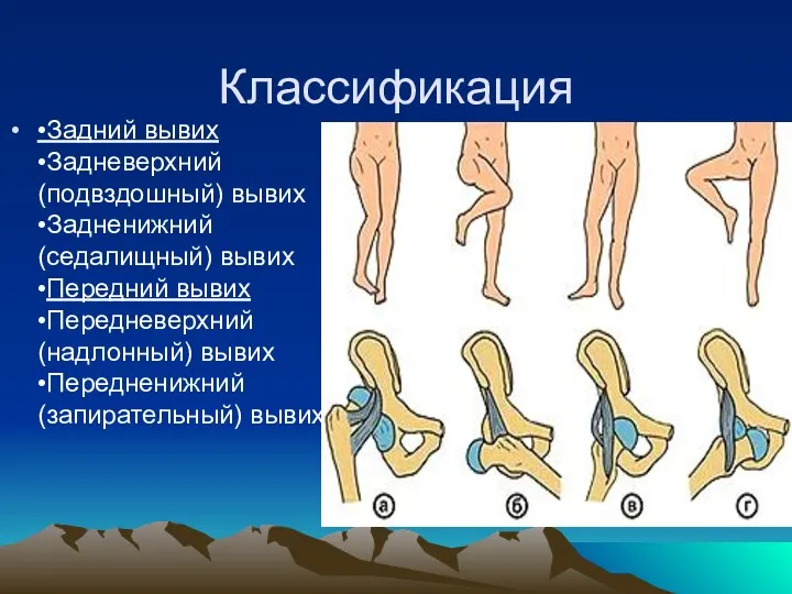 Классификация •Задний вывих •Задневерхний (подвздошный) вывих •Задненижний (седалищный) вывих •Передний