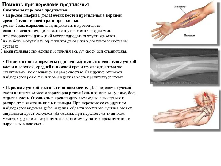 Помощь при переломе предплечья Симптомы перелома предплечья • Перелом диафиза