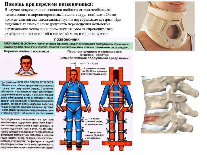 Помощь при переломе позвоночника: В случае повреждения позвонков шейного отдела