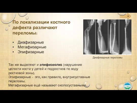 По локализации костного дефекта различают переломы: • Диафизарные • Метафизарные